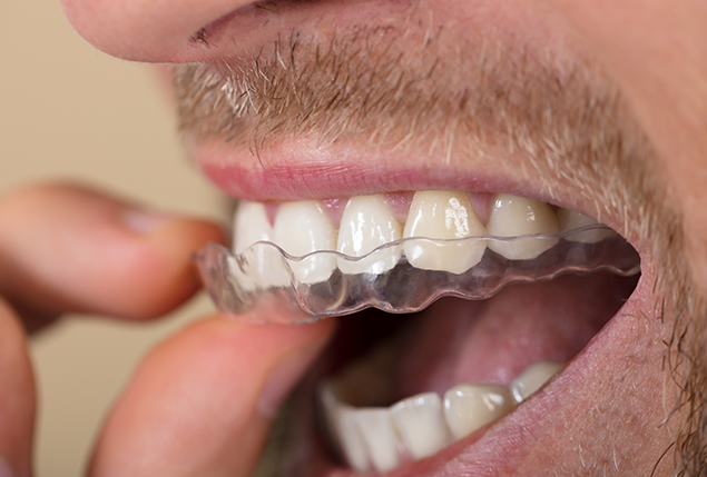 Do You Grind Your Teeth? How to Know and How to Stop