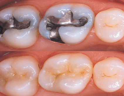 Tooth Coloured Filling