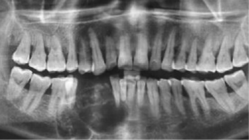 Full Mouth X-Ray